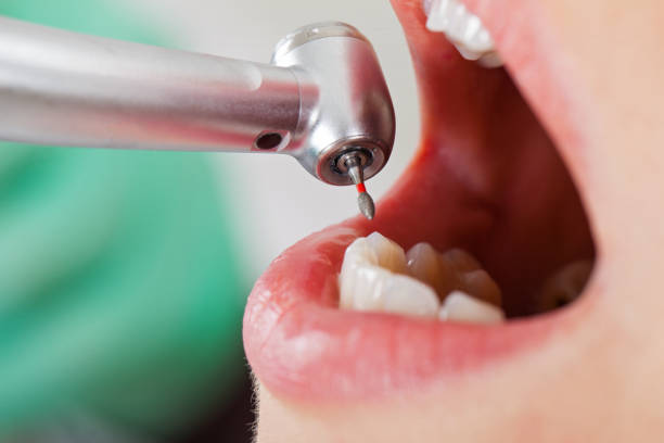 Best Emergency Broken Tooth Repair in Bothell, WA
